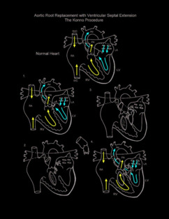 Aortic root replacement with ventricular septal defect illustration