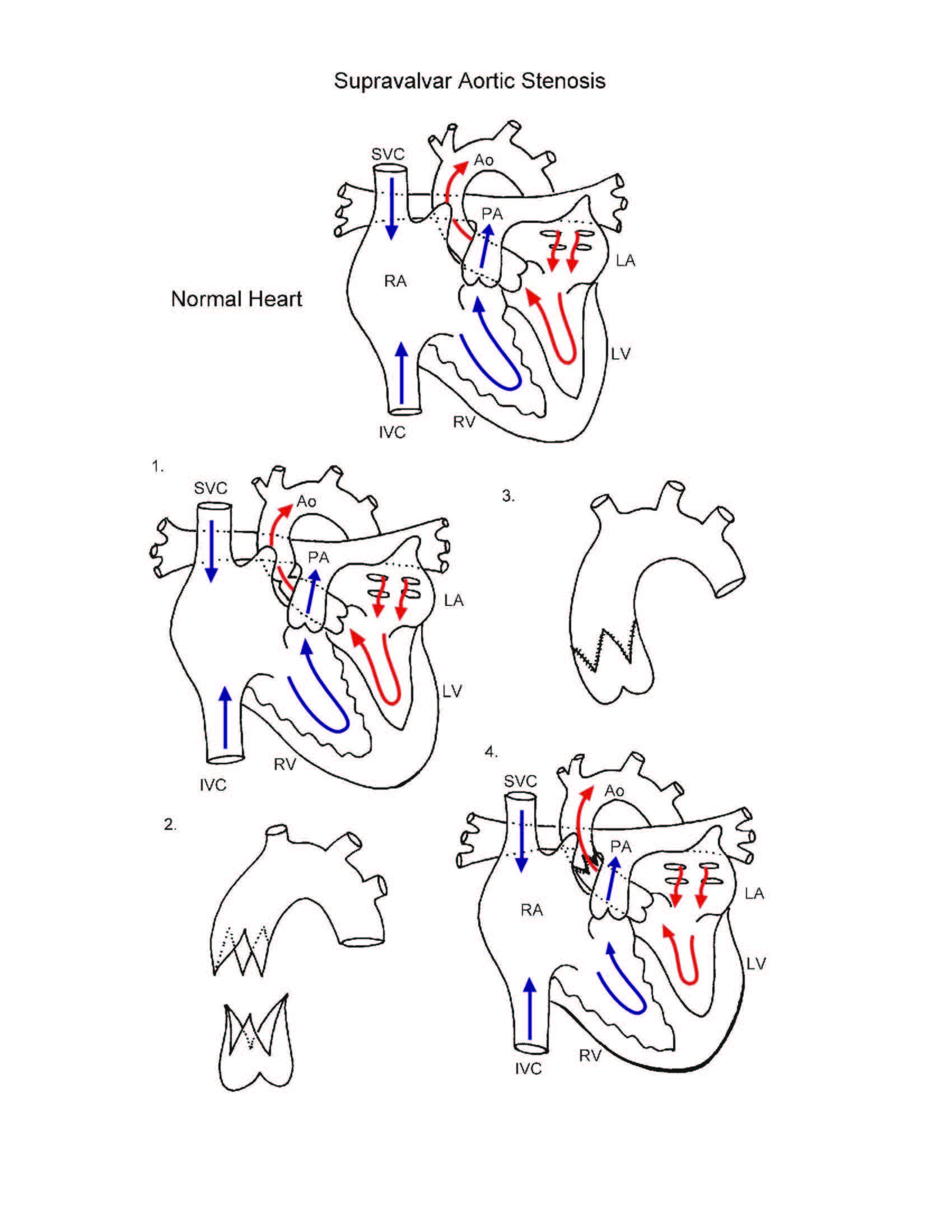 Aortic Stenosis Supravalvar illustration