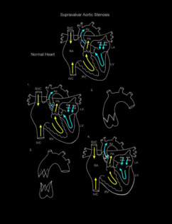 Aortic Stenosis Supravalvar illustration