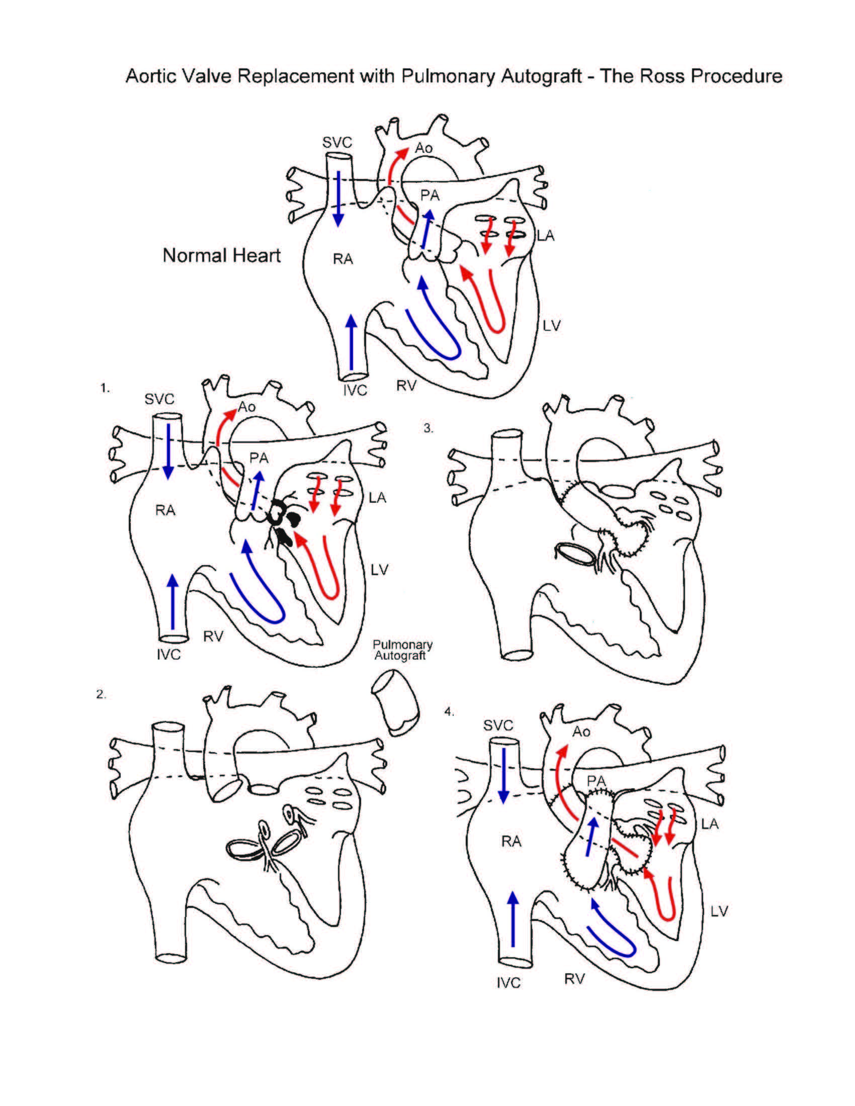 Aortic Valve Replacement with Pulmonary Autograft Ross Procedure illustration