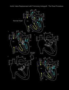 Aortic Valve Replacement with Pulmonary Autograft Ross Procedure illustration