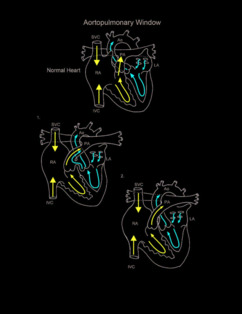 Aortopulmonary Window illustration