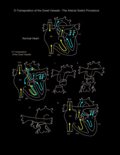 Arterial Switch Procedure illustration