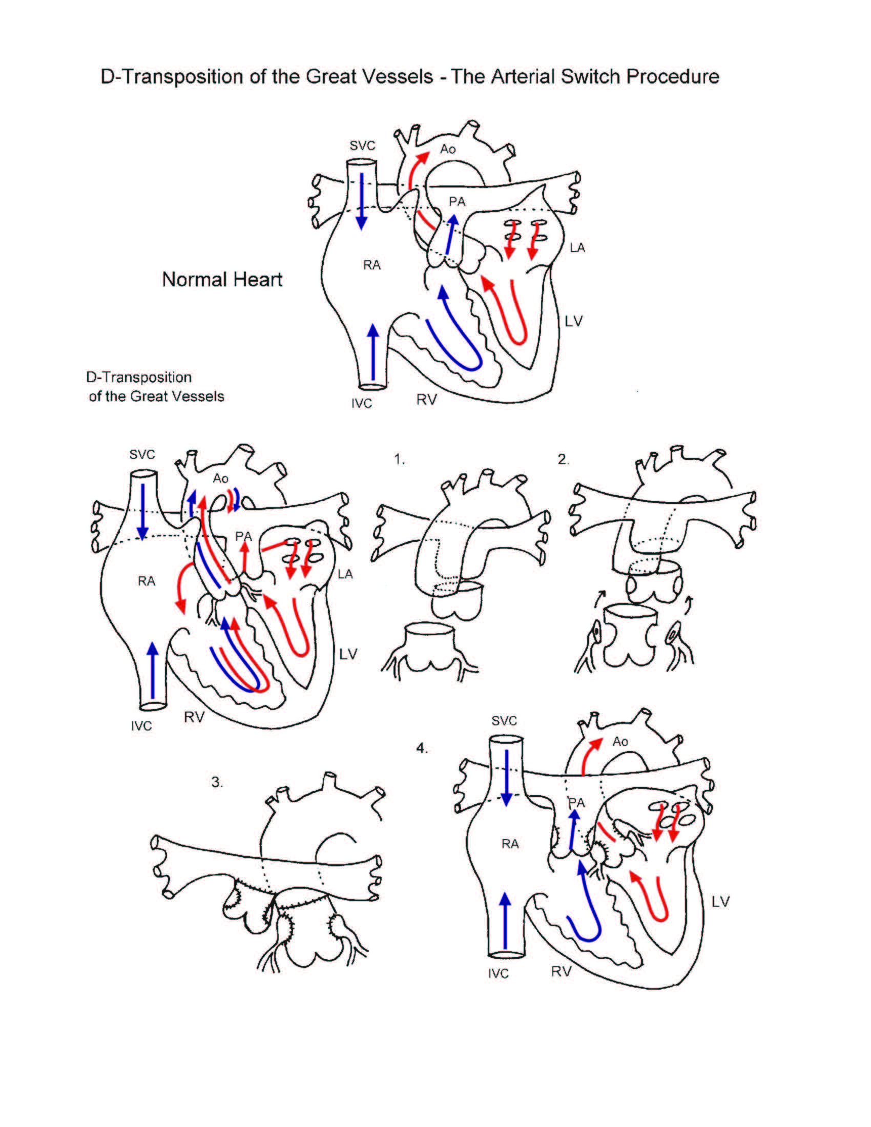 Arterial Switch Procedure illustration
