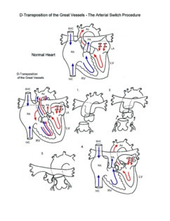 Arterial Switch Procedure illustration