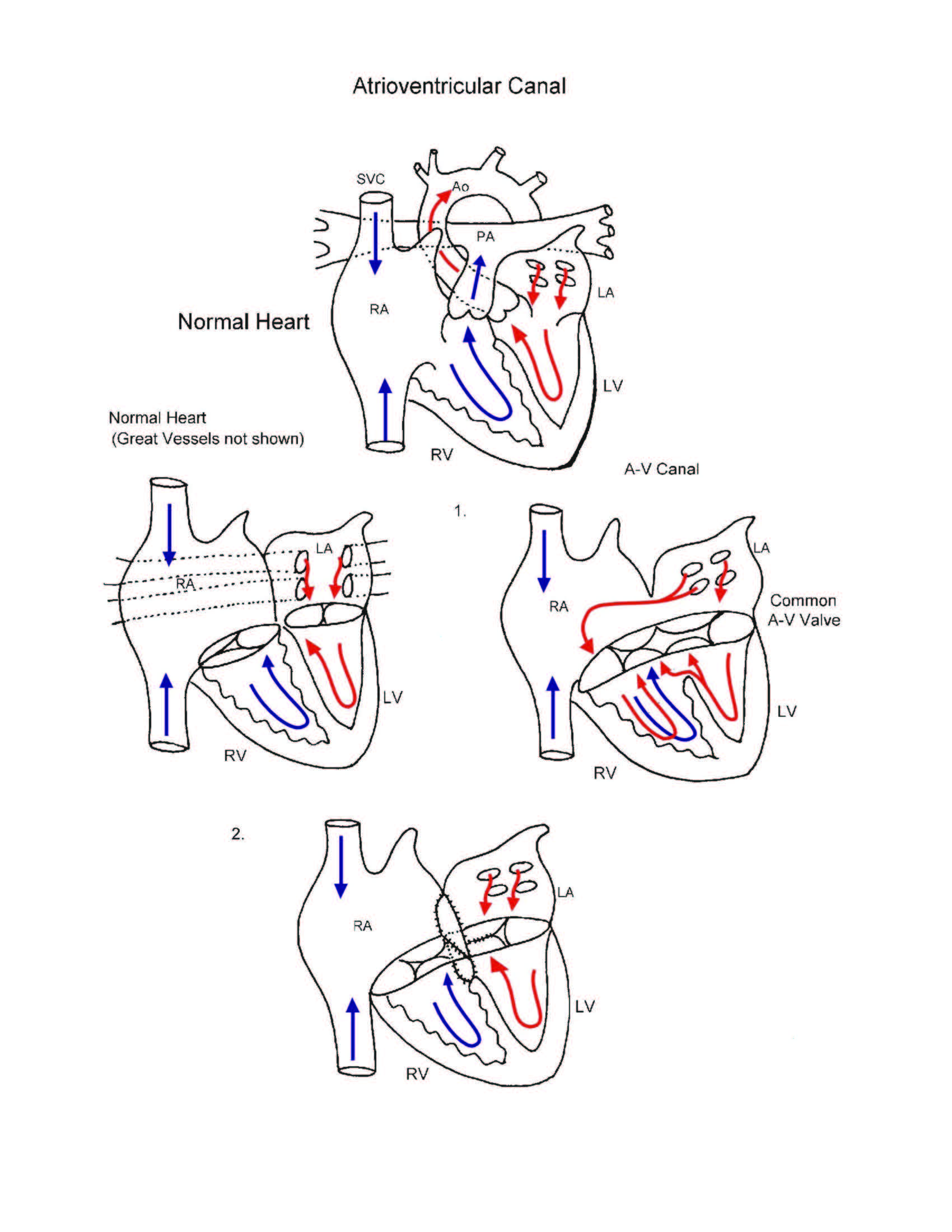 Atrioventricular Canal illustration