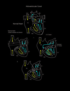Atrioventricular Canal illustration