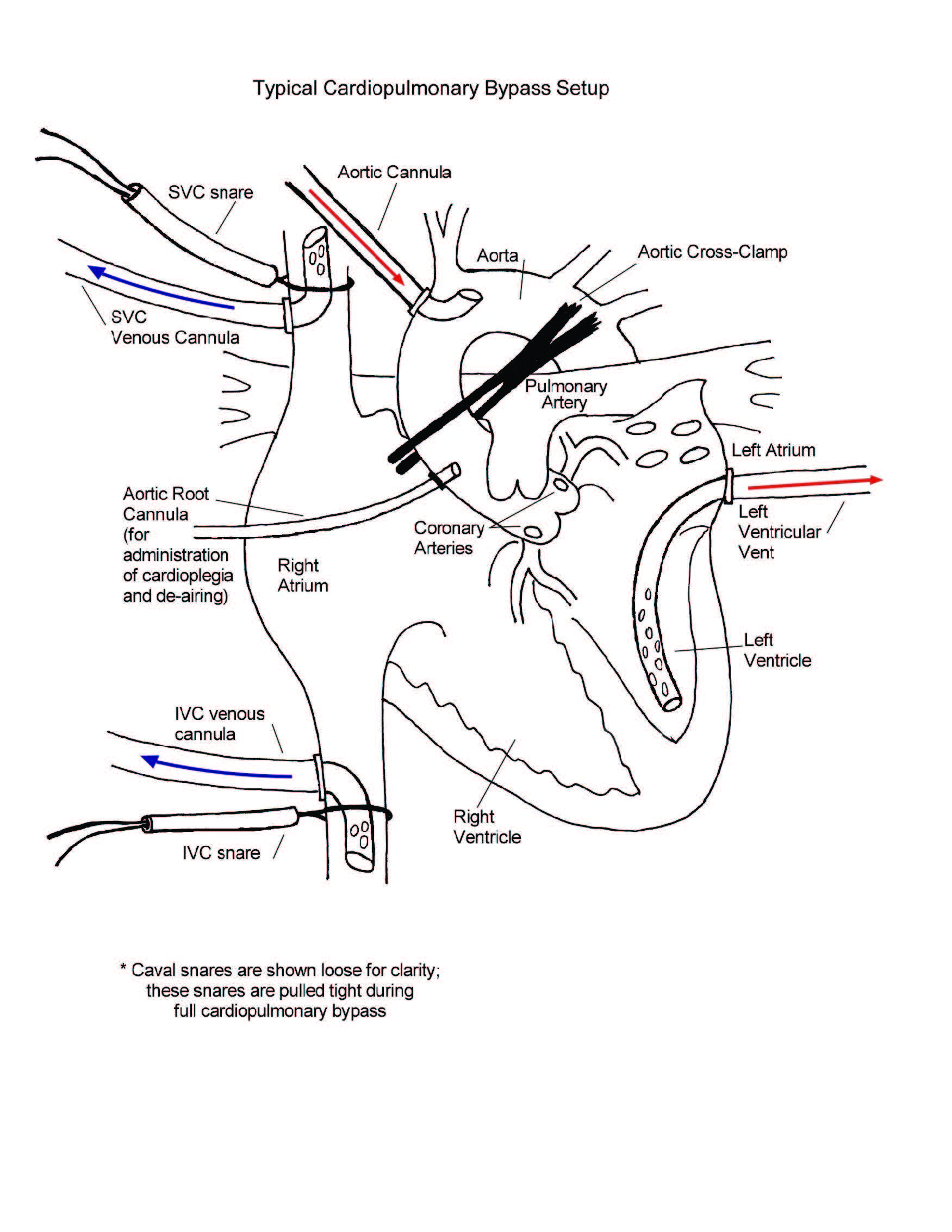 Cardiopulmonary Bypass illustration
