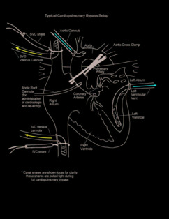 Cardiopulmonary Bypass illustration
