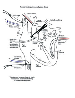 Cardiopulmonary Bypass illustration