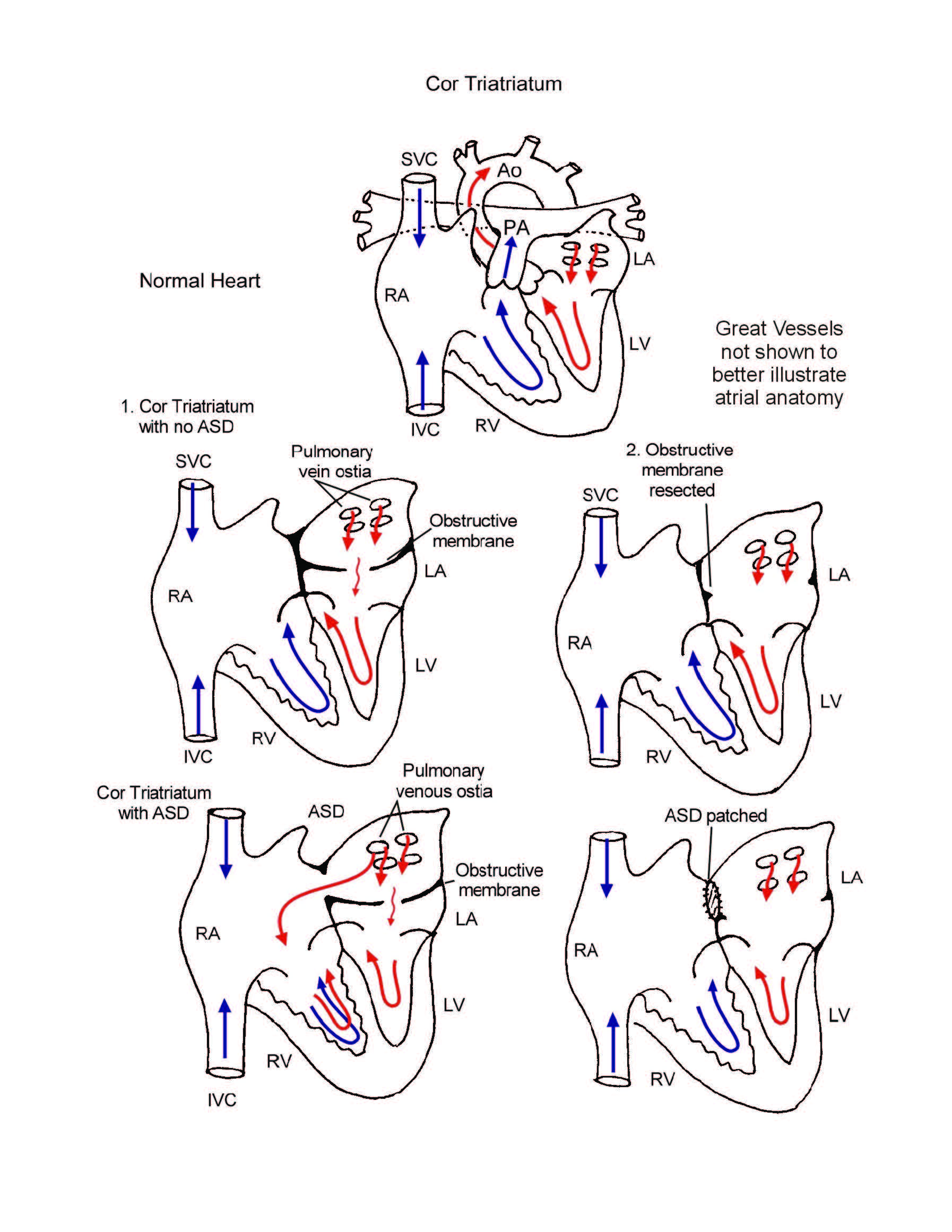 Cor Triatriatum illustration