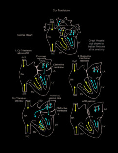 Cor Triatriatum illustration
