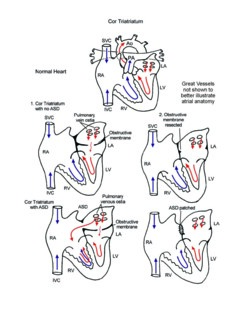 Cor Triatriatum illustration