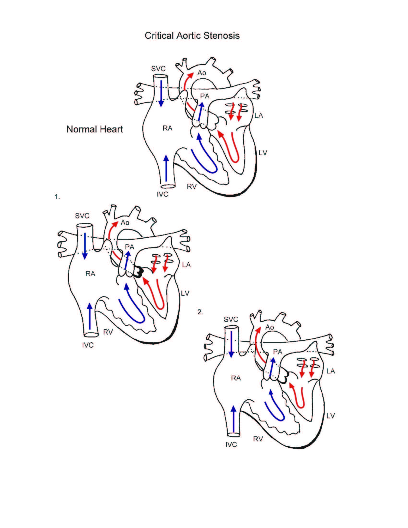 Critical Aortic Stenosis illustration