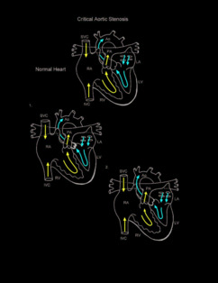 Critical Aortic Stenosis illustration