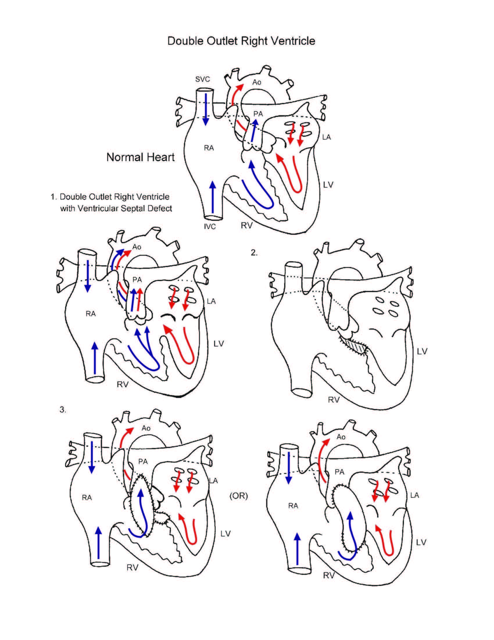 Double Outlet Right Ventricle illustration