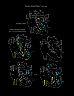 Double Outlet Right Ventricle illustration