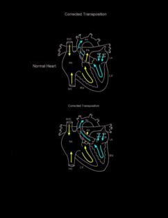 Double Switch Procedure illustration 1