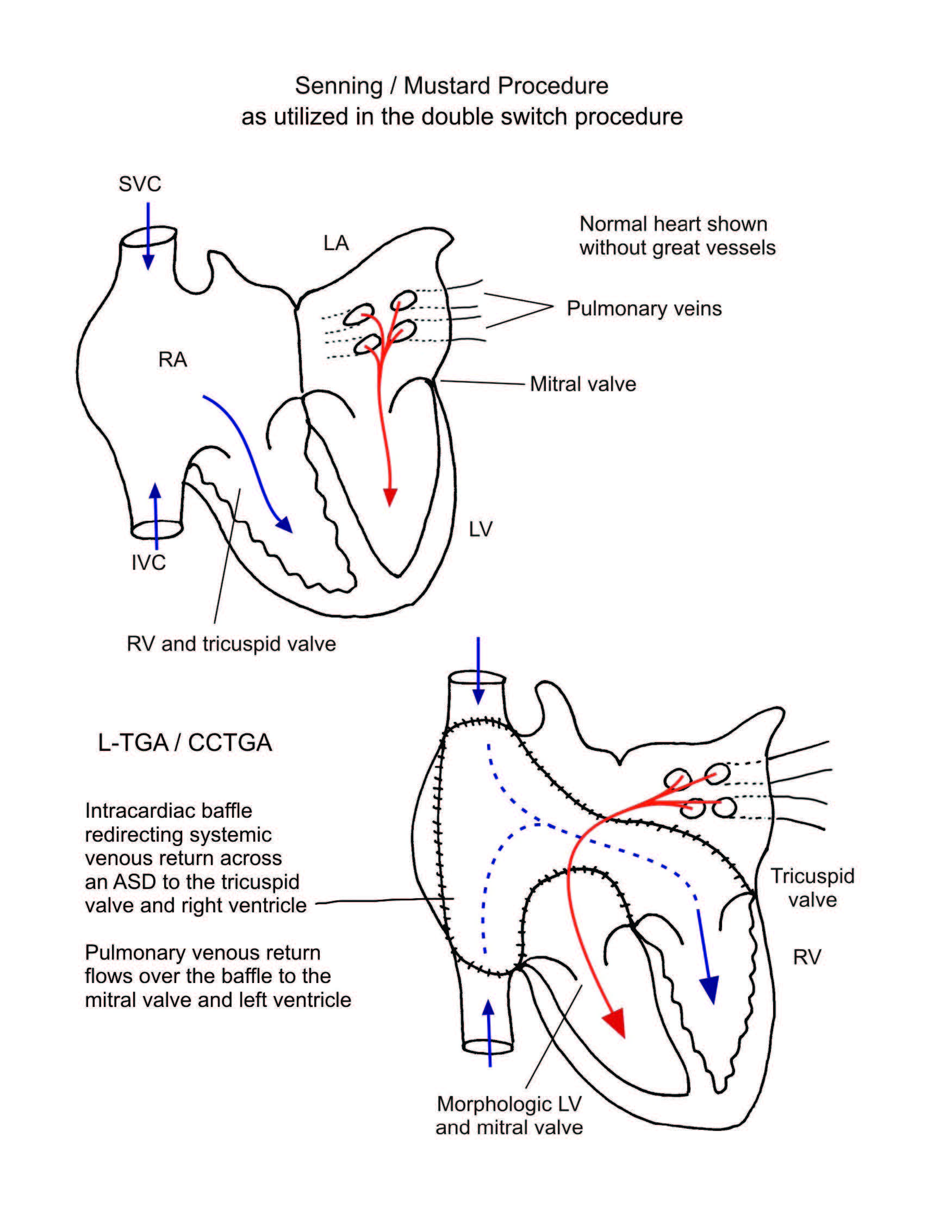 Double Switch Procedure illustration 2