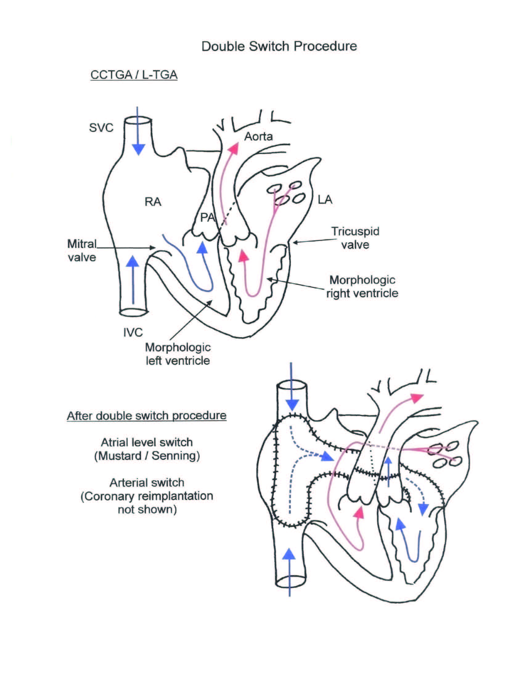 Double Switch Procedure illustration 3
