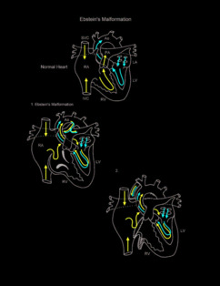 Ebsteins Anomaly illustration