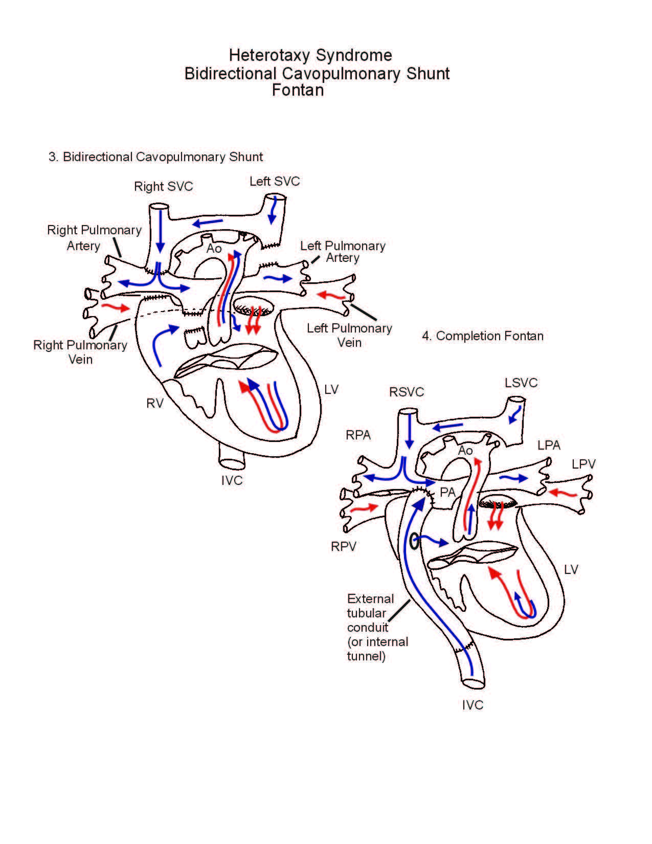 Heterotaxy Syndrome illustration 2