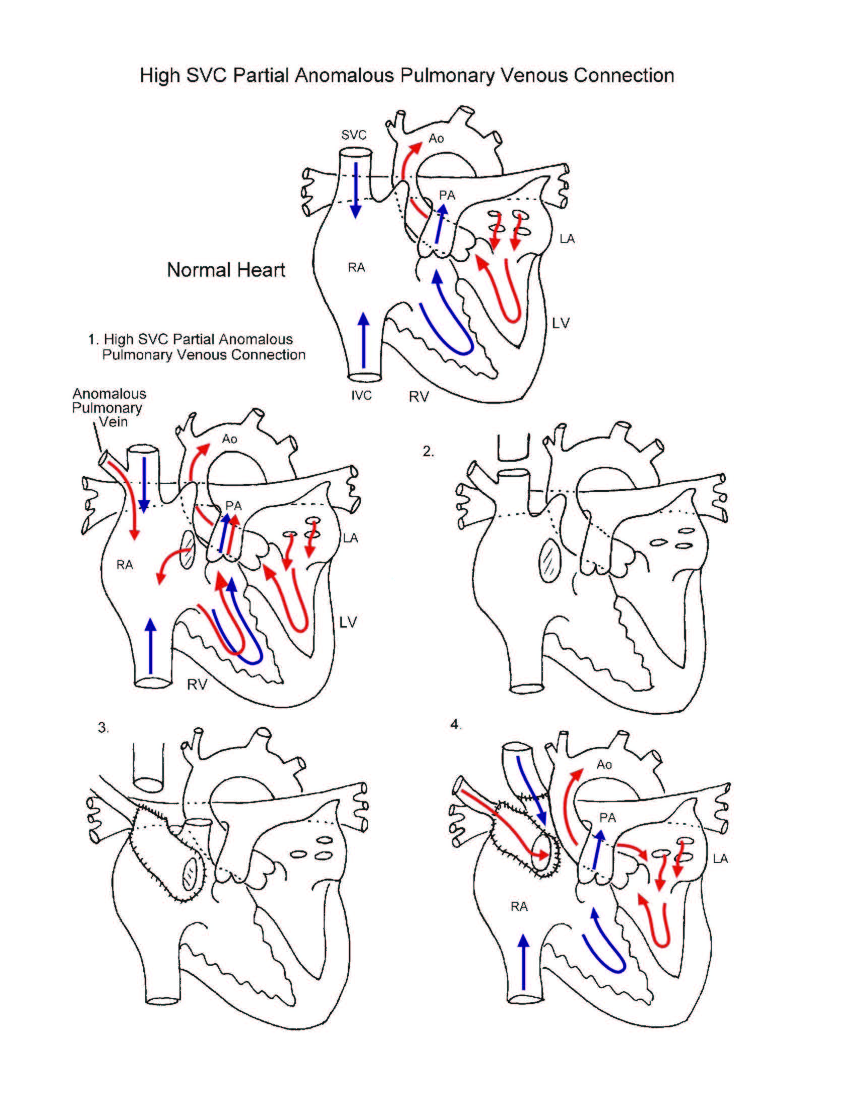 High SVC Partial Anomalous Pulmonary Venous Connection illustration