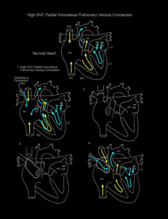 High SVC Partial Anomalous Pulmonary Venous Connection illustration