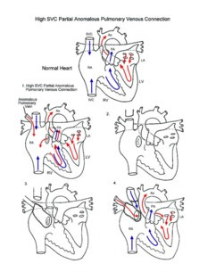 High SVC Partial Anomalous Pulmonary Venous Connection illustration