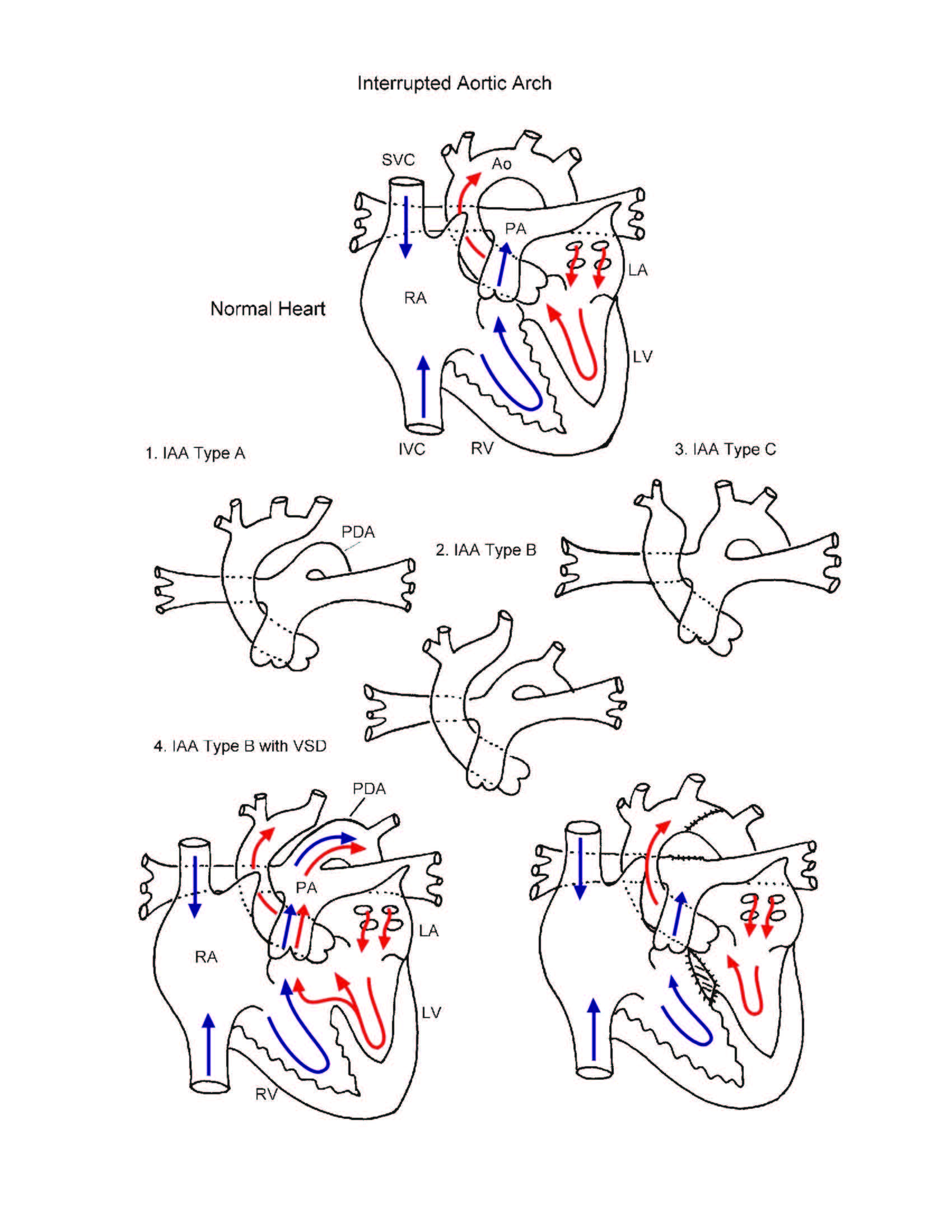 Interrupted Aortic Arch illustration
