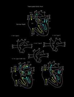 Interrupted Aortic Arch illustration
