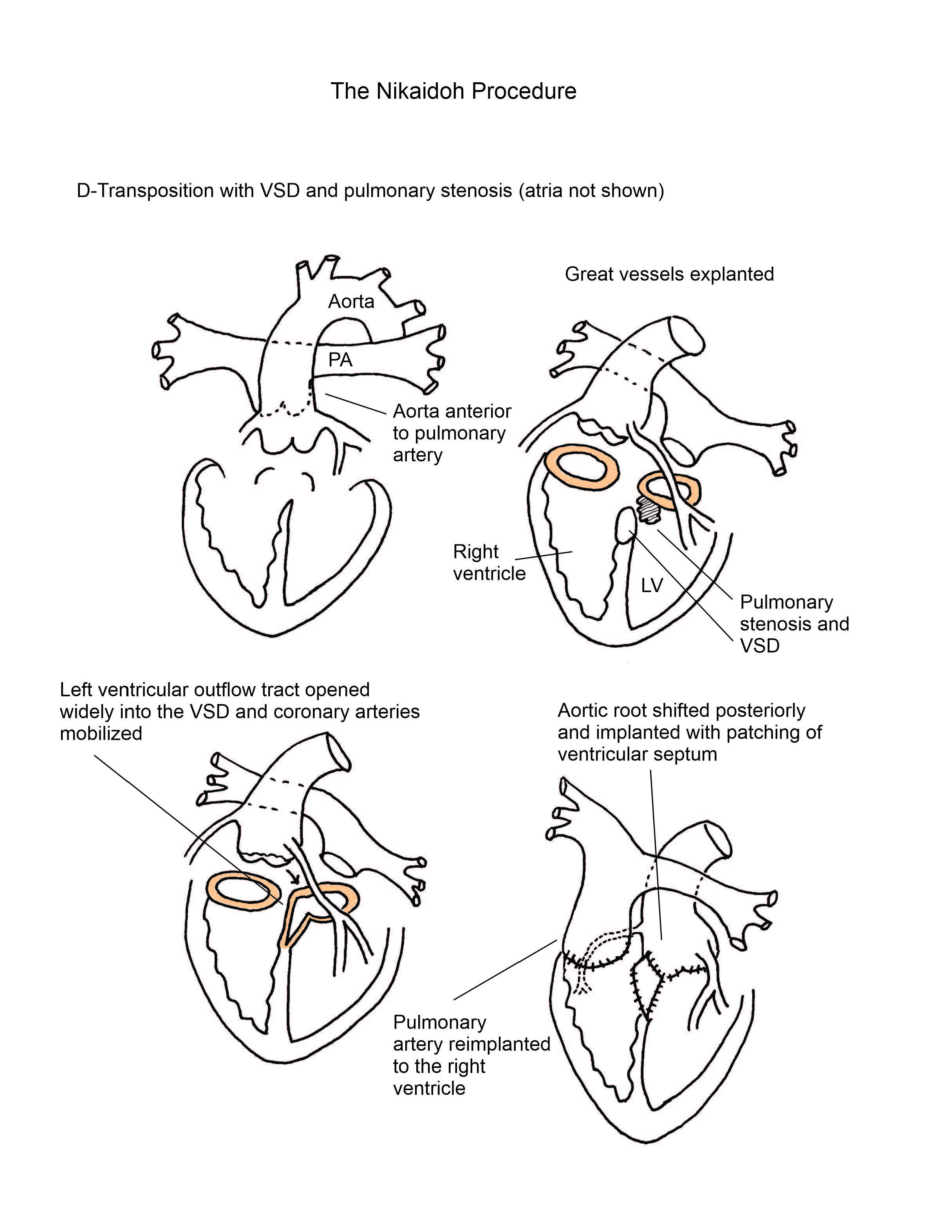 Nikaidoh Procedure illustration