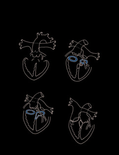 Nikaidoh Procedure illustration