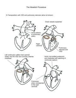 Nikaidoh Procedure illustration
