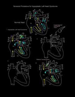 Norwood Procedure illustration 1