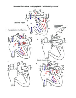 Norwood Procedure illustration 1
