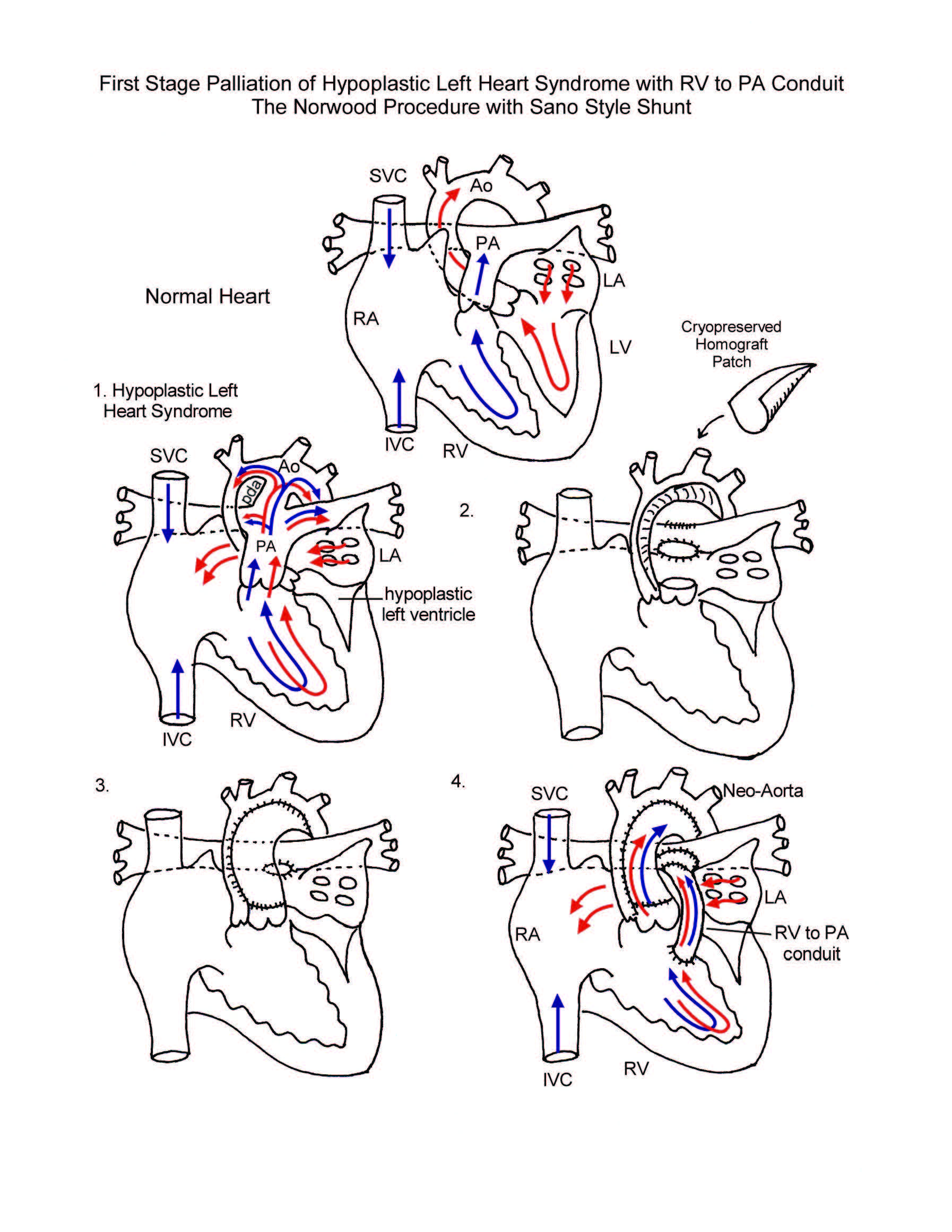 Norwood Procedure illustration 2