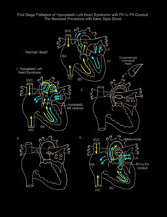 Norwood Procedure illustration 2