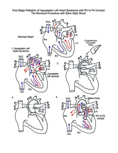 Norwood Procedure illustration 2
