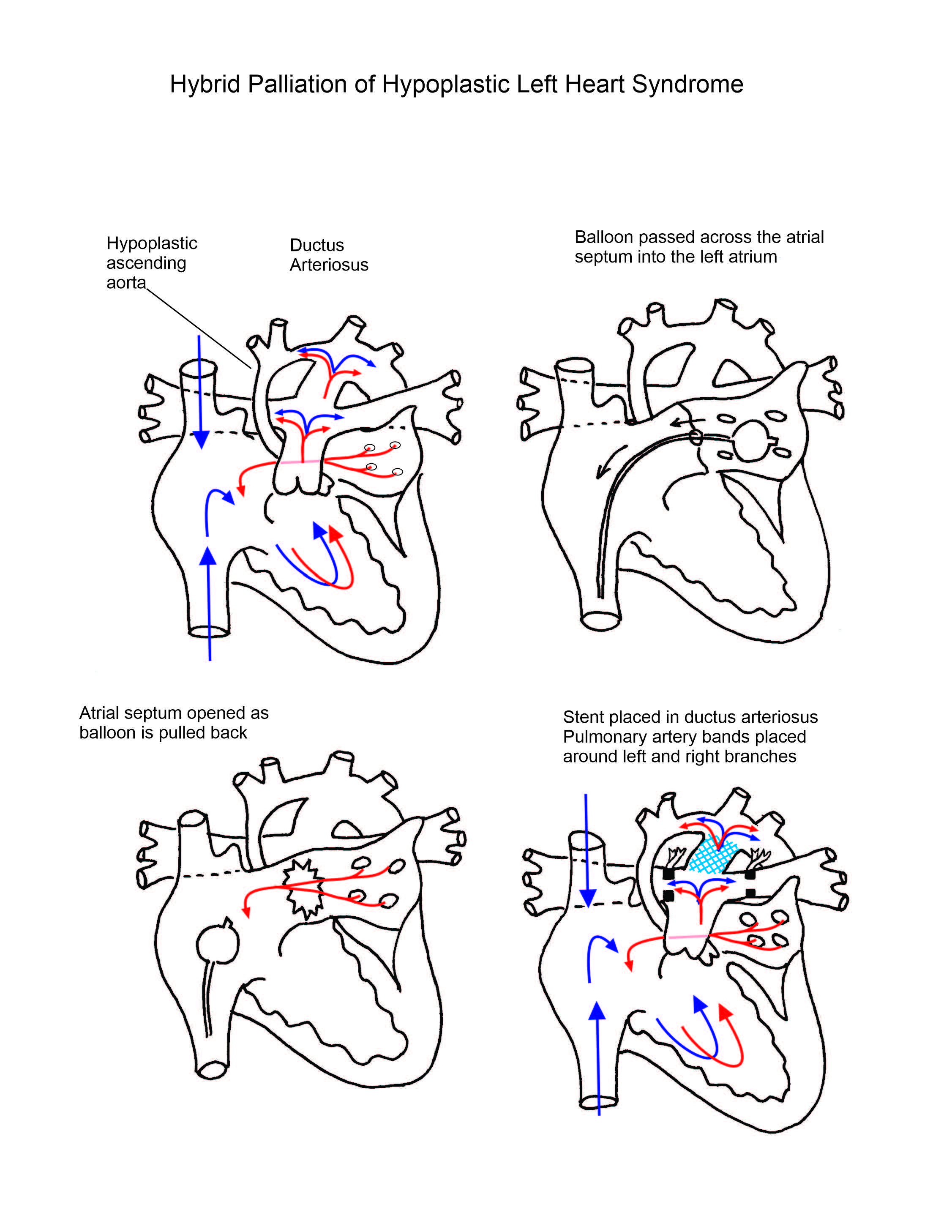 Norwood Procedure illustration 3