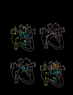 Norwood Procedure illustration 3