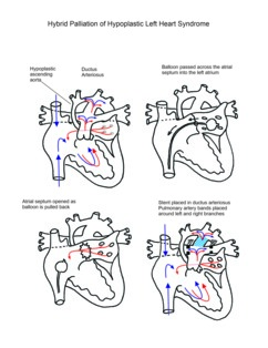 Norwood Procedure illustration 3