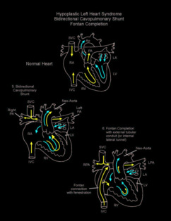 Norwood Procedure illustration 4