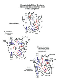 Norwood Procedure illustration 4