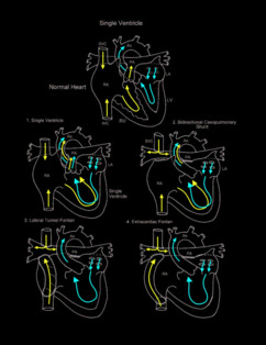 Norwood Procedure illustration 5