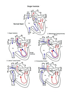 Norwood Procedure illustration 5