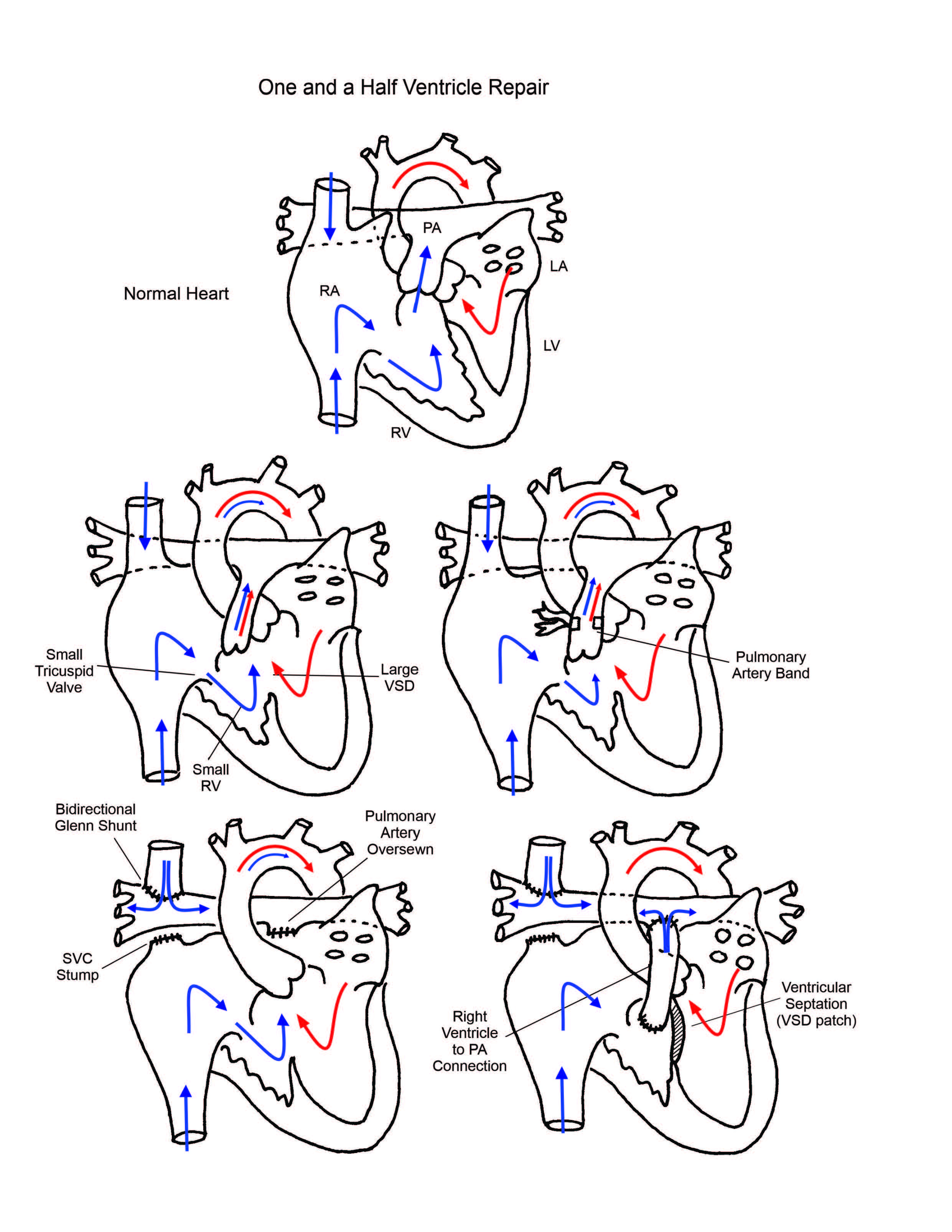 One and a half ventricle repair illustration