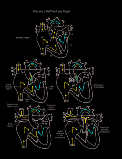 One and a half ventricle repair illustration