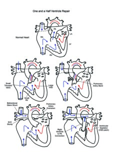One and a half ventricle repair illustration