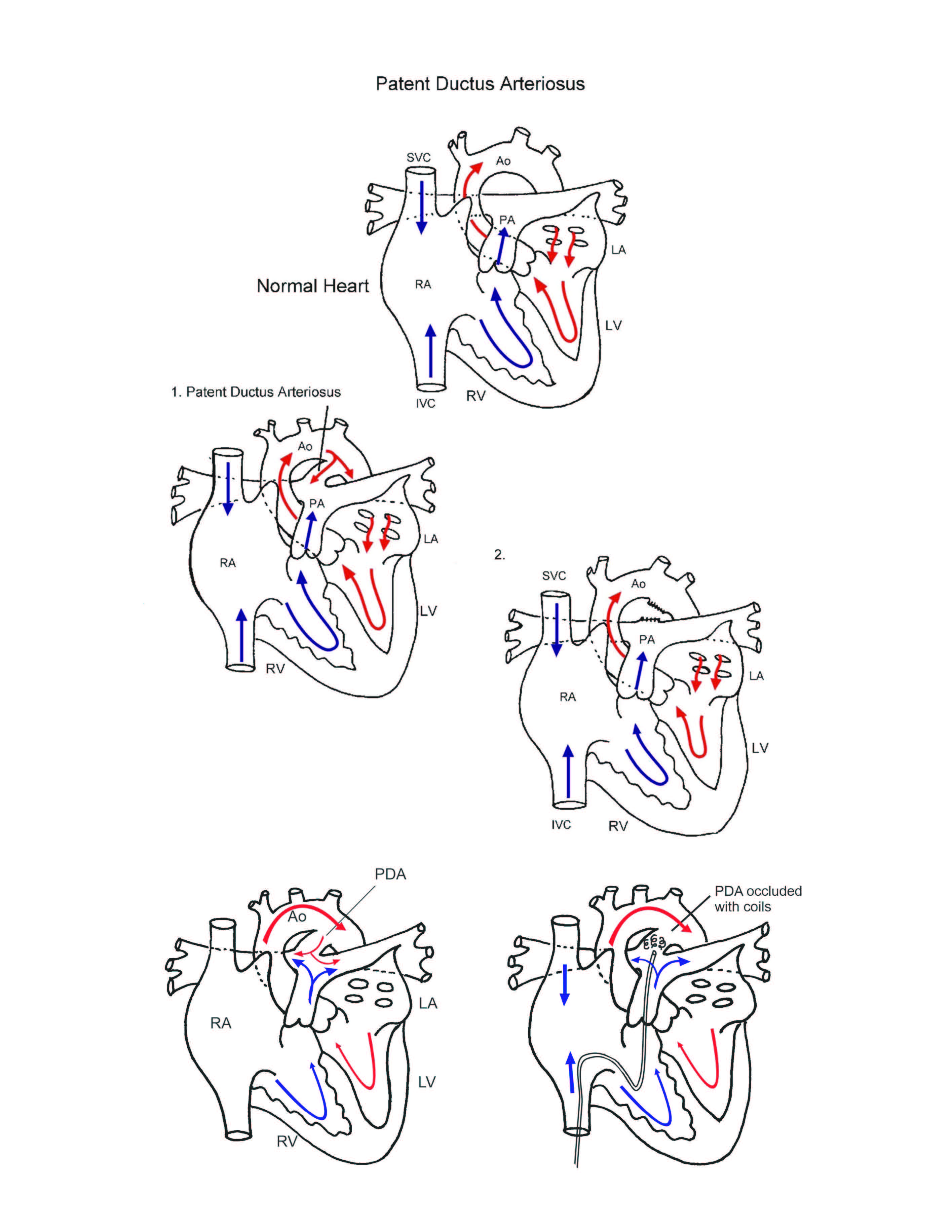 Patent Ductus Arteriosus illustration